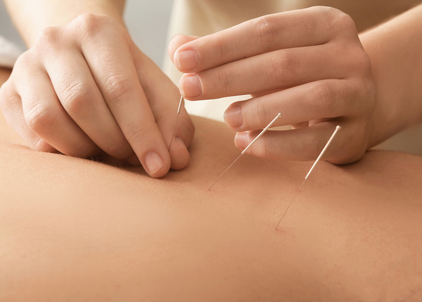 Akupunktur TCM - Komplementärtherapie